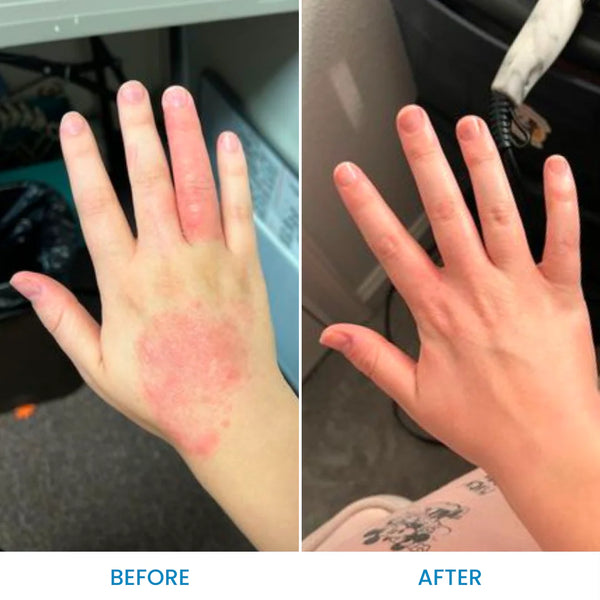 ECZEMA NATUROPATH CONSULT