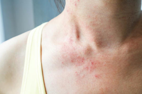 ECZEMA NATUROPATH CONSULT