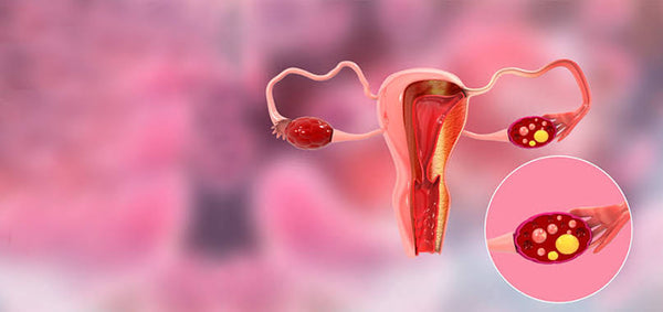 ENDOMETRIOSIS NATUROPATH PACKAGE
